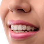 stock-photo-dental-medical-care-invisible-braces-silicone-trainer-351429728