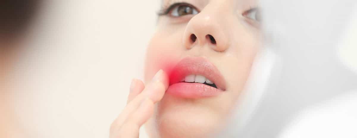 dinero flaco lineal Qué son las boqueras dentales y cómo tratarlas | Clínica dental Els Quinze