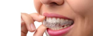 Alineadores invisibles - Clínica dental Els 15