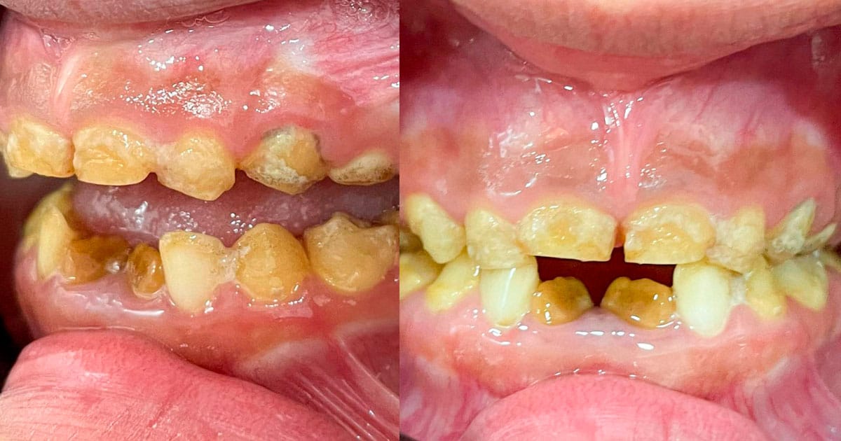 Hipoplasia del esmalte dental en niños y adultos