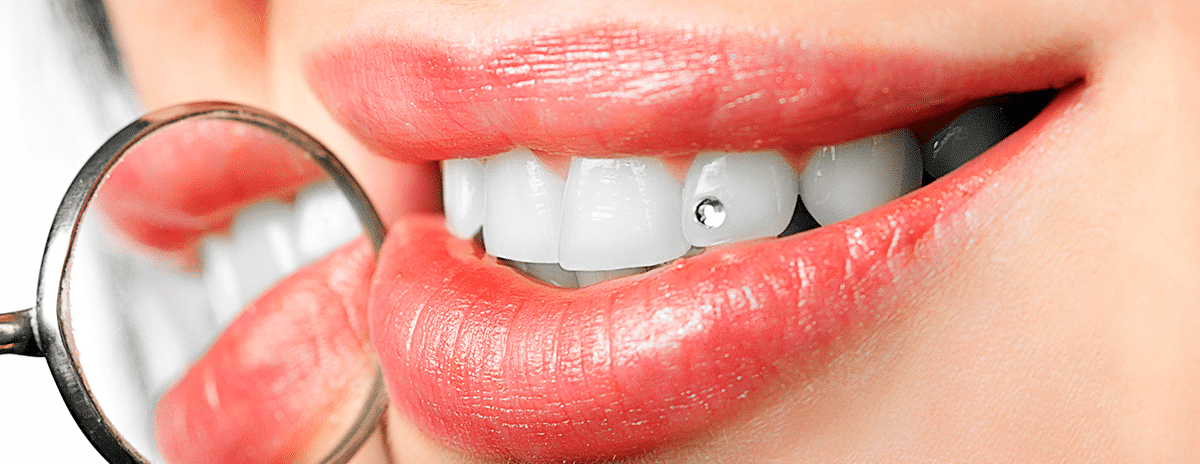 Grillz dientes - moda peligrosa - Els 15