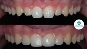 Caso real ortodoncia Els 15