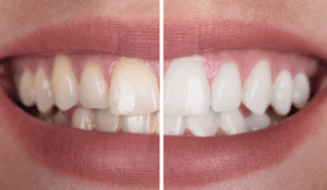 Tratamiento Estética Dental- Els Quinze