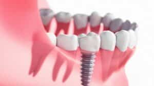 Tratamiento implantología oral - Els Quinze