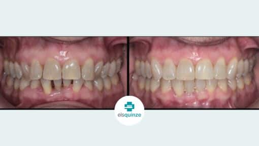 Ortodoncia antes y después