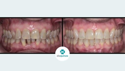 Estética dental - Ortodoncia