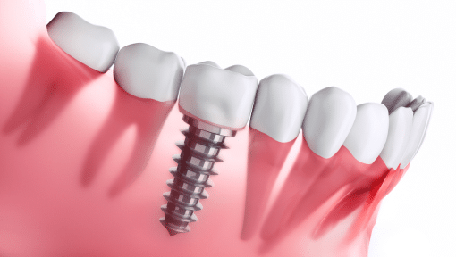 Implante dental colocación Centre Odontològic Els Quinze