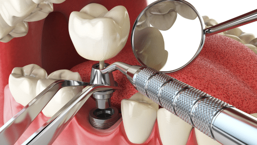Tratamientos implantes dentales