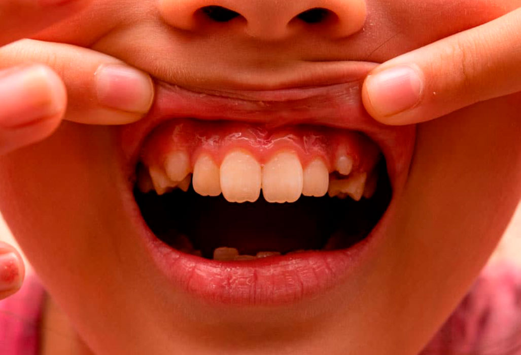 Dentición en niños - Dentició en nens - Els Quinze